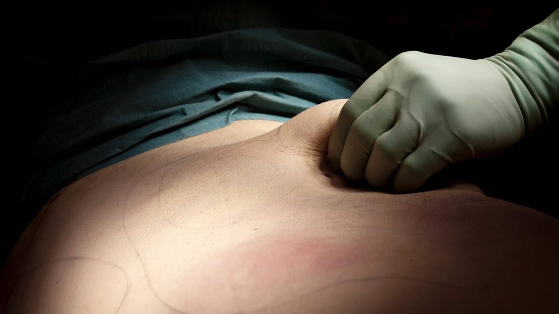 En dansk læge har sagsøgt TV 2, da han mener, at mediet i programmet "Operation X" er kommet med ærekrænkende beskyldninger mod ham om de fedmeoperationer, han udfører. (Arkivfoto). | Foto: Linda Kastrup/Ritzau Scanpix